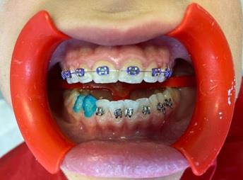 Implant Eladent