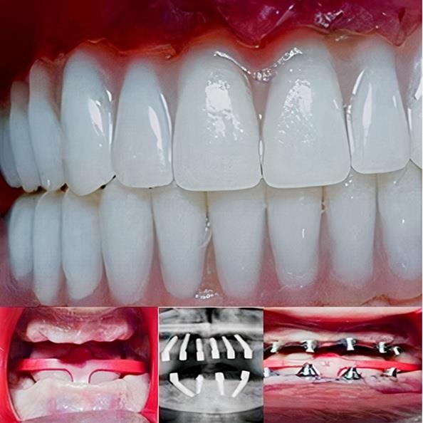 Implant Eladent